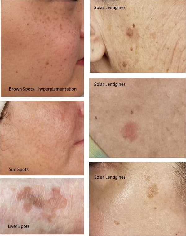 Brown Skin Spots - When not to worry about the brown spots on your