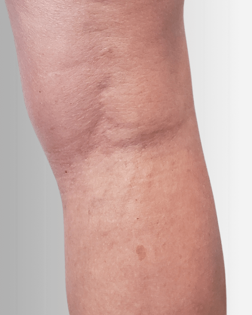 DO After Right leg