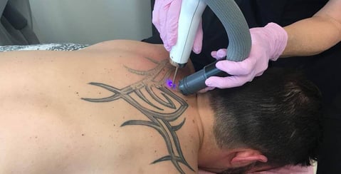 Laser tattoo removal - homepage tile