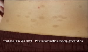 Post Inflammatory Hyperpigmentation