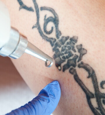 Laser Tattoo Removal  Louisville Laser and Spa  Groupon