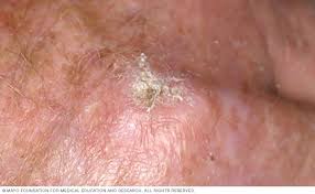 How To Remove Brown Spots How To Remove Brown Spots