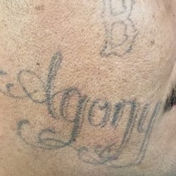 Tattoo Removal Before & After in Denver | youbaby Skin Spa