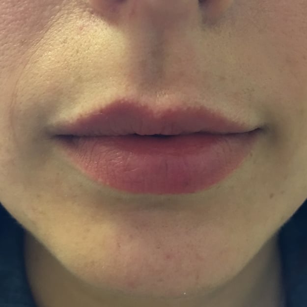 Lip Color Permanent Makeup Before & After in Denver | youbaby Skin Spa