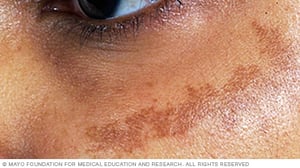 How To Remove Brown Spots How To Remove Brown Spots