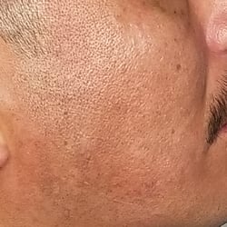 rt cheek after 8 txts