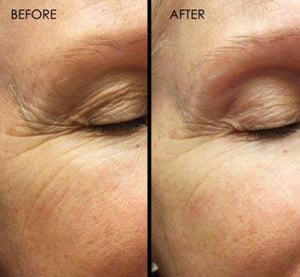 Pin By On Beauty Skin Care Led Face Mask Face Mapping Acne Face Acne