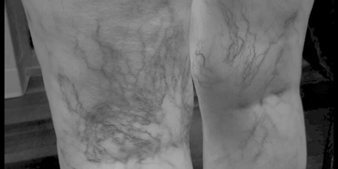 Black and white image of visible leg veins before treatment