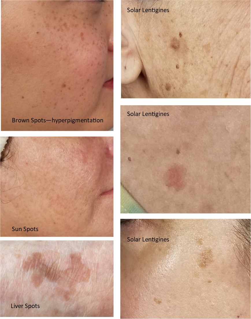 How To Remove Brown Spots How To Remove Brown Spots