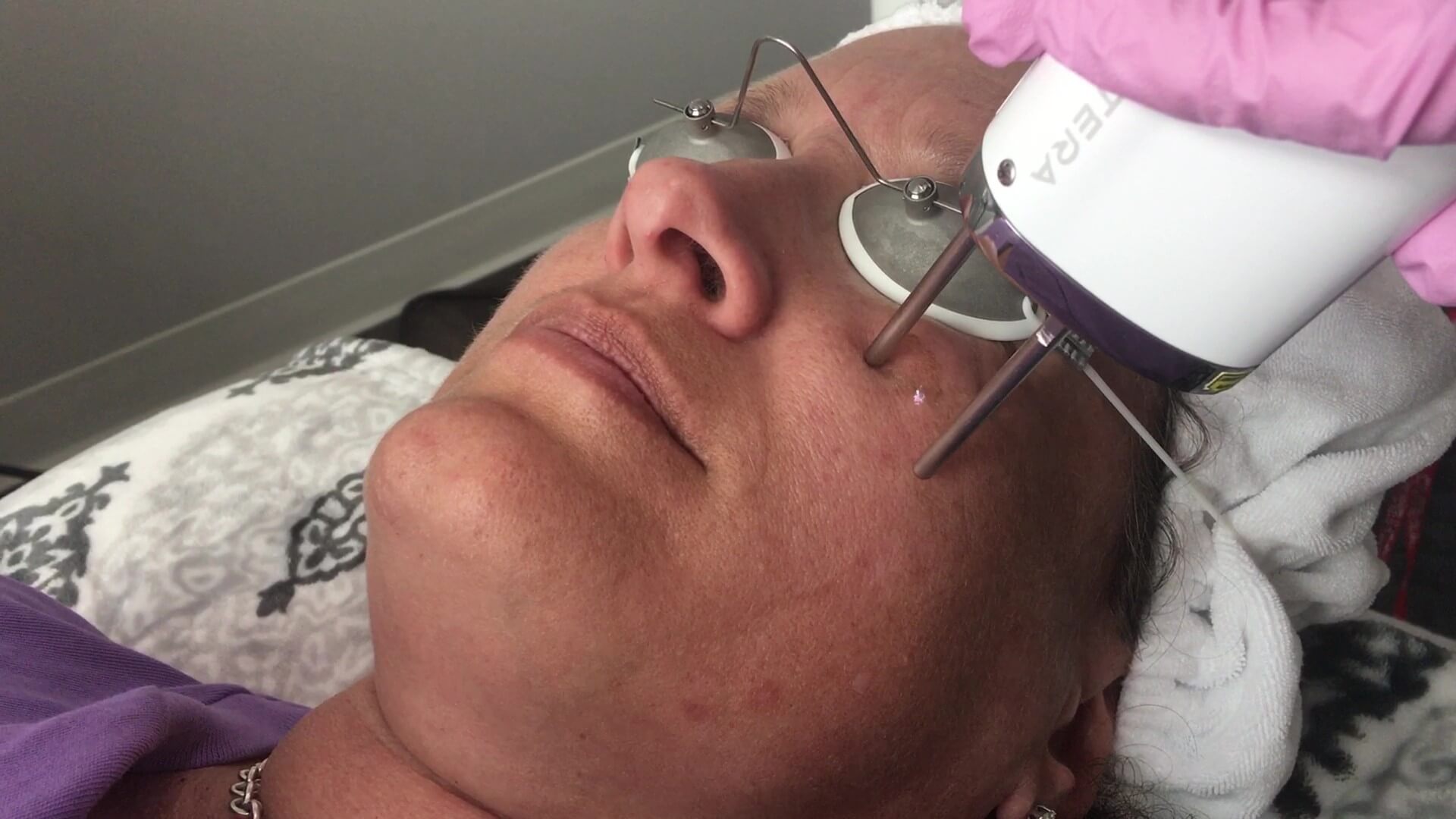 PICO Genesis treatment
