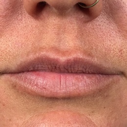 Lips-before-2-1